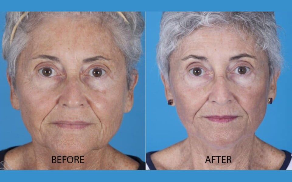 Facial Plastic Surgery Results, San Antonio, TX